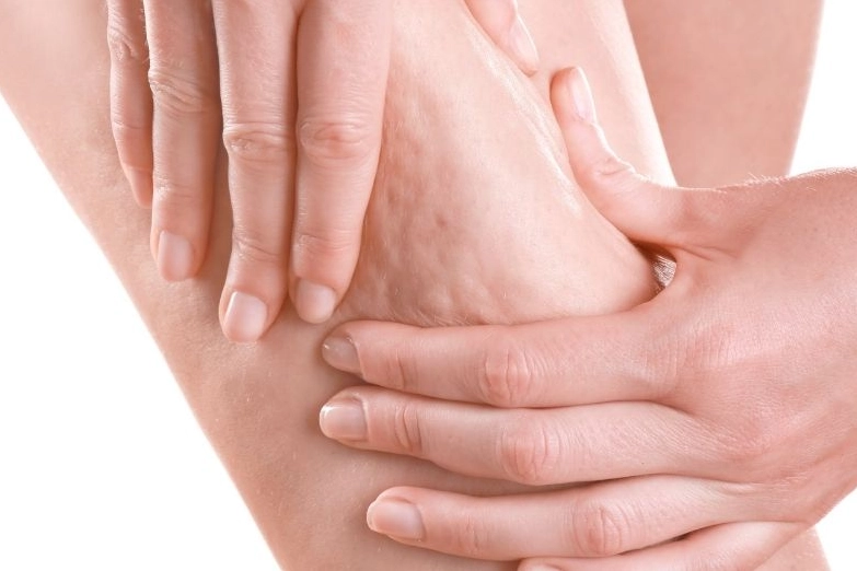 Sel&uuml;lit Estetik Değil, Metabolik Bir Hastalığın İşareti